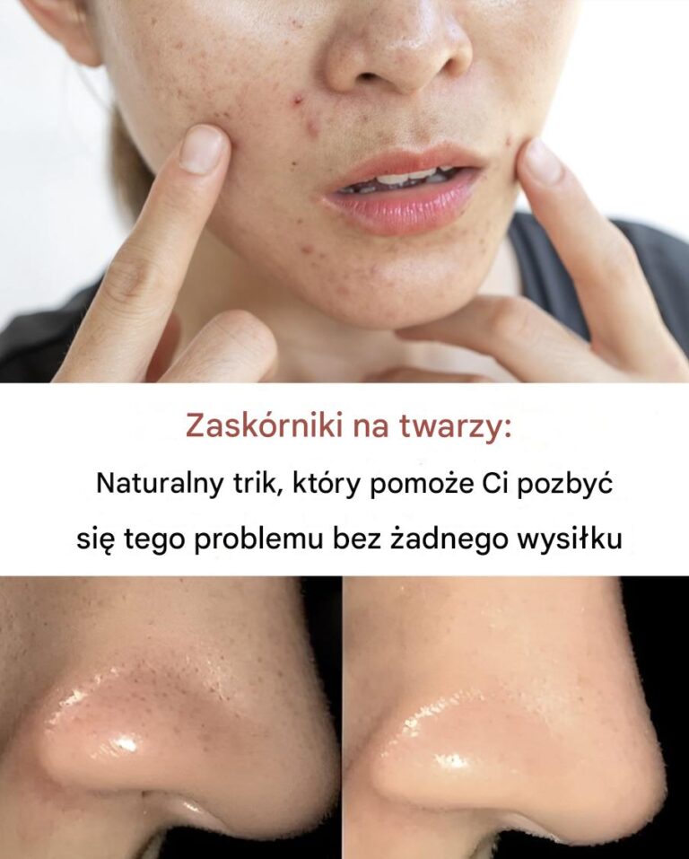 Jak_usun___zask_rniki_z_twarzy_