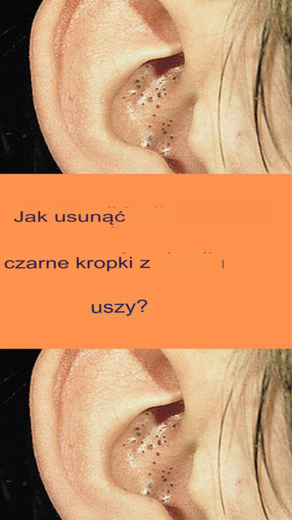 Jak_usun___zask_rniki_z_uszu_ Jak_usun___zask_rniki_z_uszu_