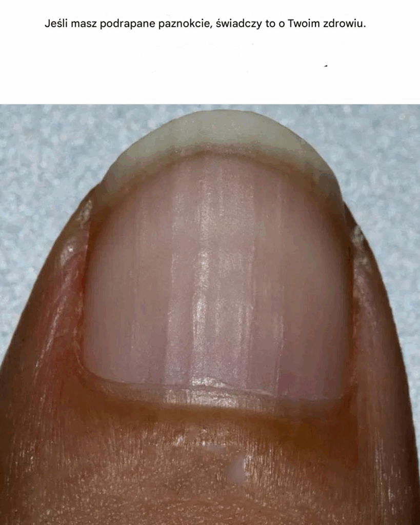 Je_li_masz_bruzdy_na_paznokciach___wiadczy_to_o_Twoim_zdrowiu_ Je_li_masz_bruzdy_na_paznokciach___wiadczy_to_o_Twoim_zdrowiu_