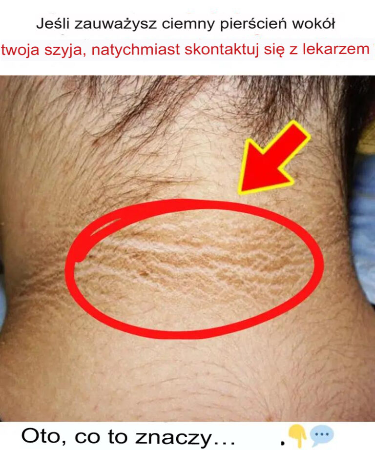 Je_li_zauwa_ysz_ciemn__obw_dk__wok___szyi__natychmiast_udaj_si__do_lekarza__Oto__co_to_oznacza