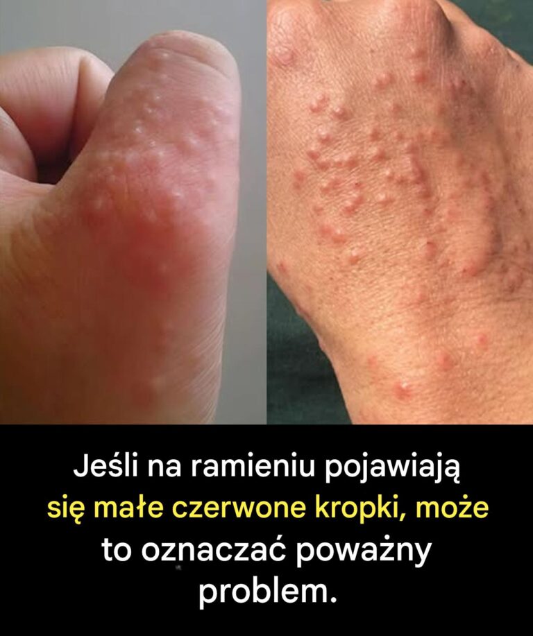 Masz_te_ma_e_czerwone_plamy_na_ramieniu__Oto__co_one_maj__na_my_li_