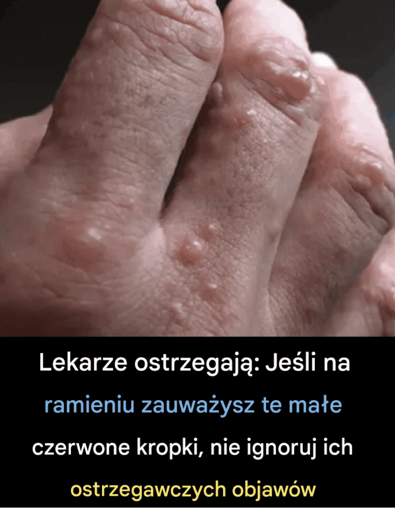Nie_ignoruj___tych_ma_ych_czerwonych_plamek_na_ramieniu___mog__by__wa_nymi_znakami_ostrzegawczymi Nie_ignoruj___tych_ma_ych_czerwonych_plamek_na_ramieniu___mog__by__wa_nymi_znakami_ostrzegawczymi