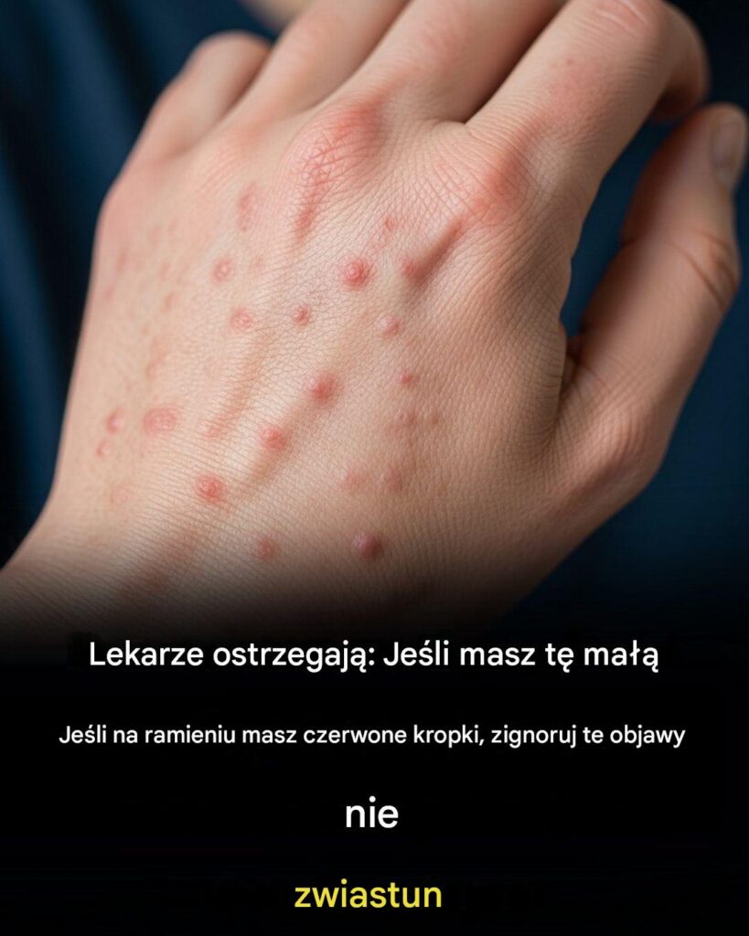 Nie_ignoruj_tych_ma_ych_czerwonych_plamek_na_ramieniu___mog__to_by__wa_ne_sygna_y_ostrzegawcze Nie_ignoruj_tych_ma_ych_czerwonych_plamek_na_ramieniu___mog__to_by__wa_ne_sygna_y_ostrzegawcze
