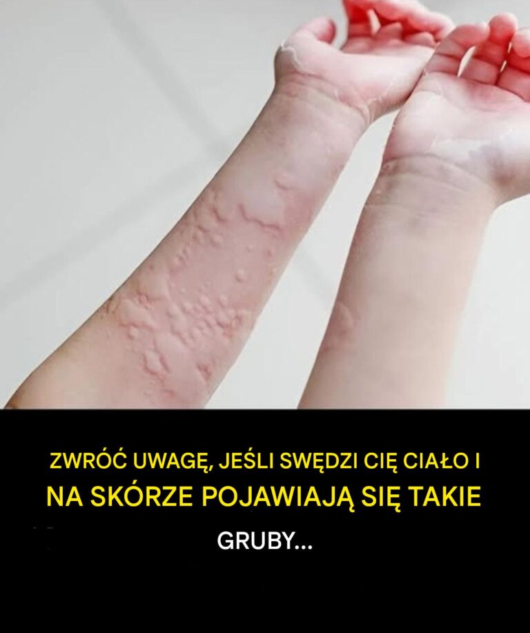 Odkryto_zaskakuj_ce_przyczyny_pokrzywki