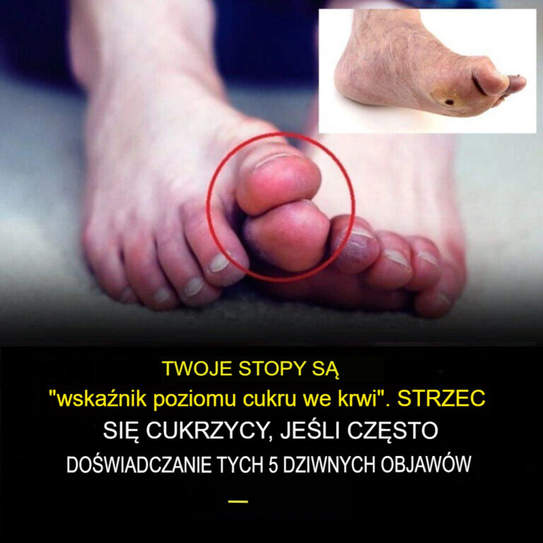 Oto_pi___nietypowych_objaw_w_wysokiego_poziomu_cukru_we_krwi__na_kt_re_nale_y_zwr_ci__uwag__w_przypadku_st_p_