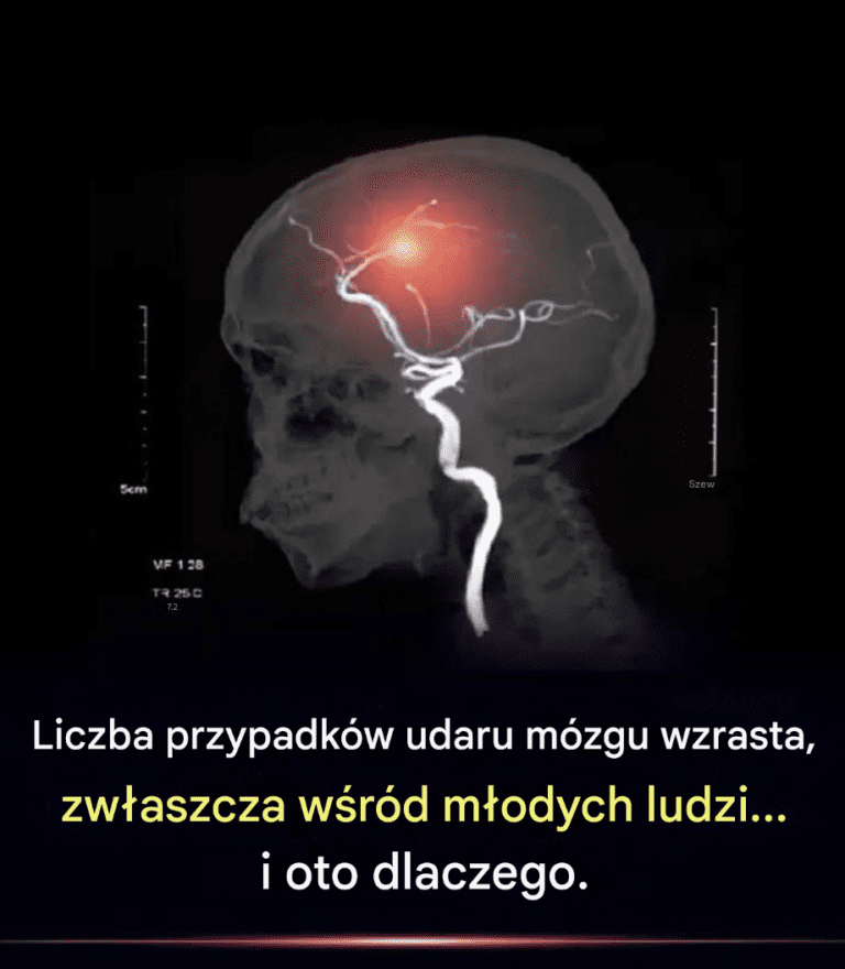 Przypadki_udaru_m_zgu_zdarzaj__si__coraz_cz__ciej__zw_aszcza_w_r_d_m_odych_ludzi__i_oto_dlaczego_ Przypadki_udaru_m_zgu_zdarzaj__si__coraz_cz__ciej__zw_aszcza_w_r_d_m_odych_ludzi__i_oto_dlaczego_