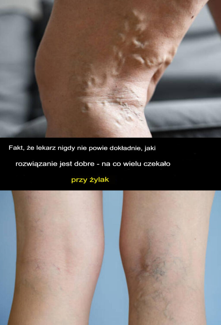 To__czego_Tw_j_lekarz_nigdy_Ci_nie_powie__okazuje_si__rozwi_zaniem__na_kt_re_czeka_o_wiele_os_b_w_walce_z__ylakami