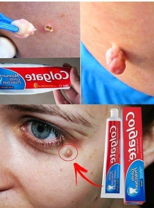 Usu__ciemne_plamy__ciemne_smugi_i_naturalne_przebarwienia Usu__ciemne_plamy__ciemne_smugi_i_naturalne_przebarwienia