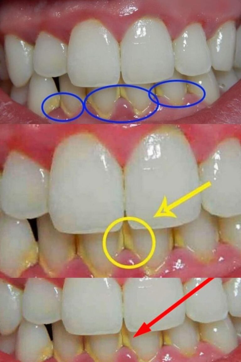 Usu__p_ytk__naz_bn__w_5_minut_w_spos_b_naturalny__bez_wizyty_u_dentysty