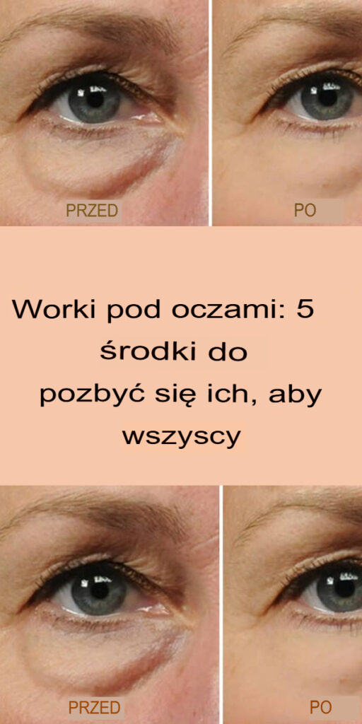 Worki_pod_oczami__5_sposob_w__aby_pozby__si__ich_na_zawsze Worki_pod_oczami__5_sposob_w__aby_pozby__si__ich_na_zawsze