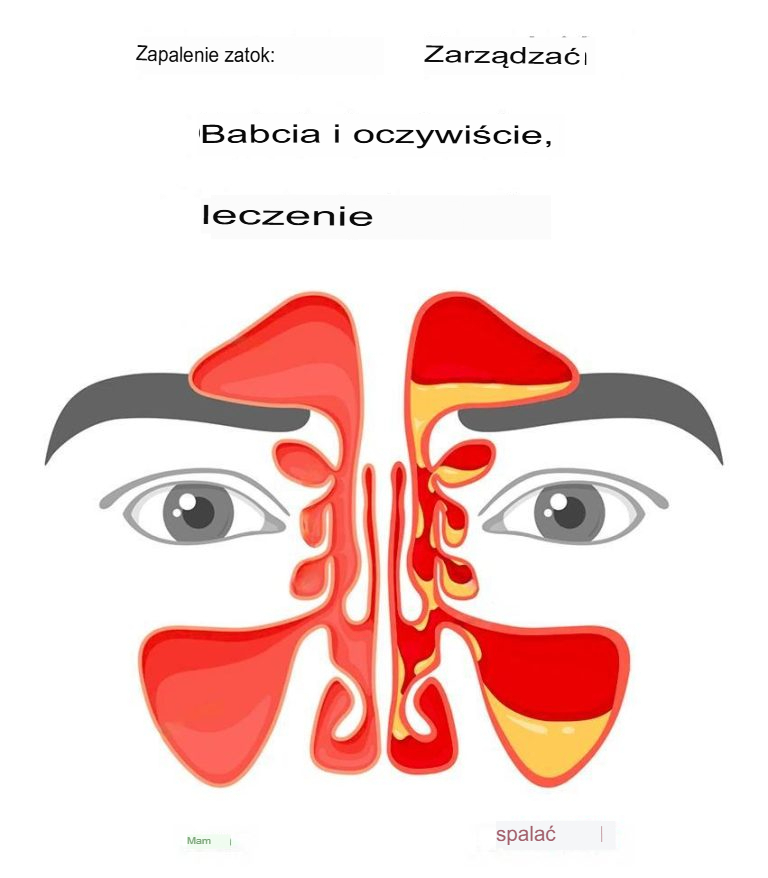 Zapalenie_zatok__babcine_sposoby_i_naturalne_metody_leczenia Zapalenie_zatok__babcine_sposoby_i_naturalne_metody_leczenia