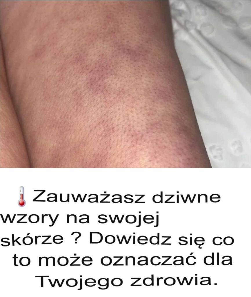 Zauwa_asz_dziwne_wzory_na_sk_rze__Dowiedz_si___co_mog__oznacza__dla_Twojego_zdrowia_