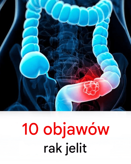 10_objaw_w_raka_jelita_grubego 10_objaw_w_raka_jelita_grubego