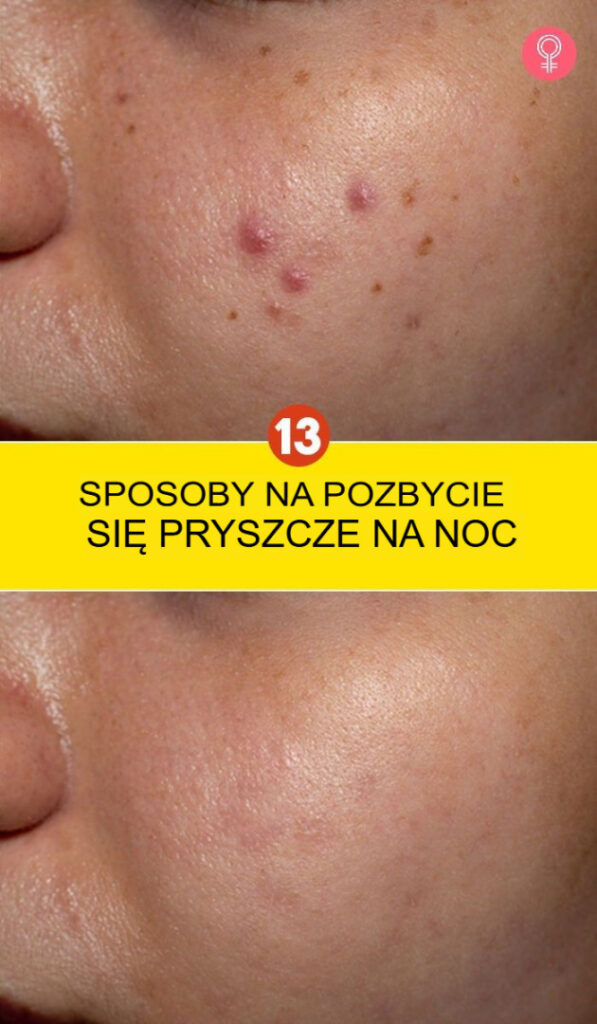 13_sposob_w_na_pozbycie_si__pryszczy_w_ci_gu_nocy 13_sposob_w_na_pozbycie_si__pryszczy_w_ci_gu_nocy