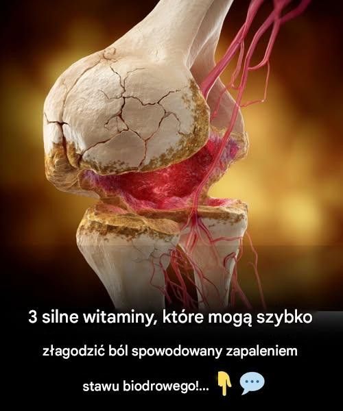 3_najlepsze_witaminy_na_zapalenie_stawu_biodrowego___po_egnaj_si__z_b_lem_stawu_biodrowego