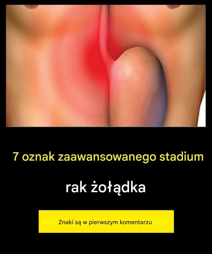 7_objaw_w_zaawansowanego_raka__o__dka 7_objaw_w_zaawansowanego_raka__o__dka