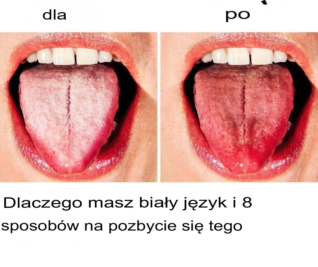 Dlaczego_j_zyk_robi_si__bia_y_i_8_sposob_w__jak_si__go_pozby_ Dlaczego_j_zyk_robi_si__bia_y_i_8_sposob_w__jak_si__go_pozby_