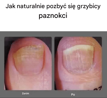 Jak_naturalnie_pozby__si__grzybicy_paznokci Jak_naturalnie_pozby__si__grzybicy_paznokci