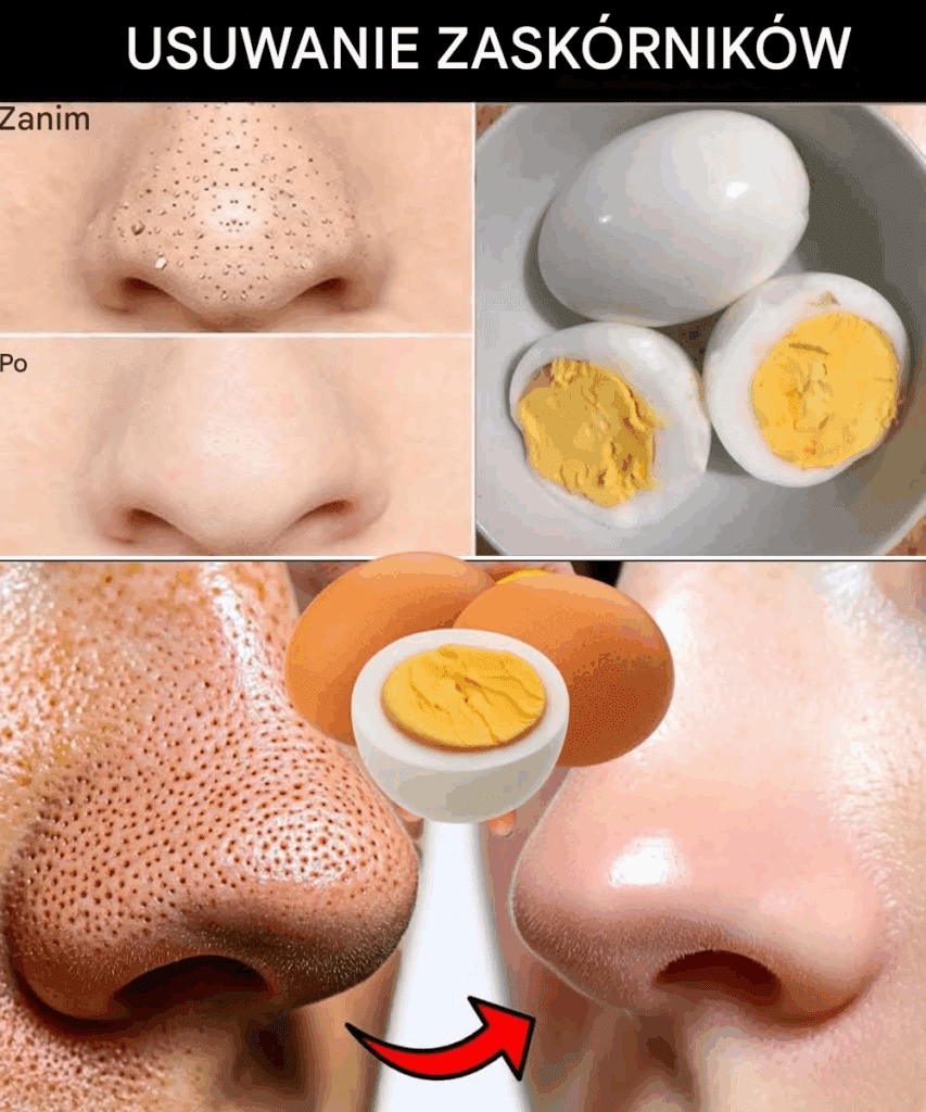 Po_egnaj_si__z_Blackheads_z_jednym_jajkiem___8211__oto_jak_ Po_egnaj_si__z_Blackheads_z_jednym_jajkiem___8211__oto_jak_