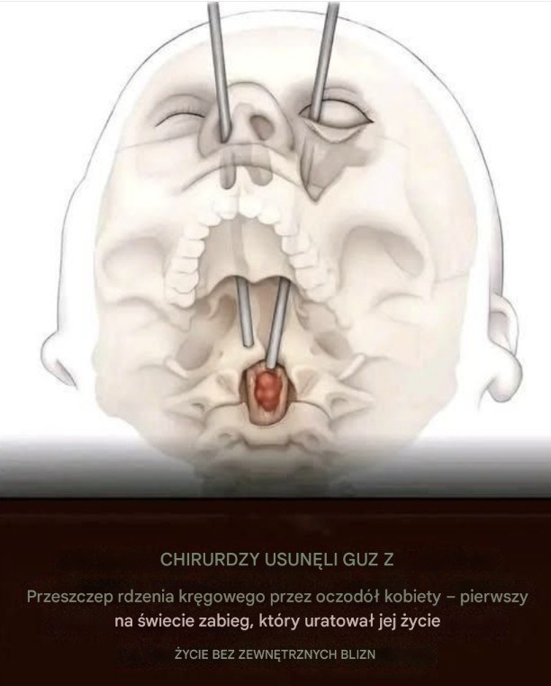 Rewolucyjna_operacja_usuni_cia_guza_kr_gos_upa_przez_oczod__ Rewolucyjna_operacja_usuni_cia_guza_kr_gos_upa_przez_oczod__
