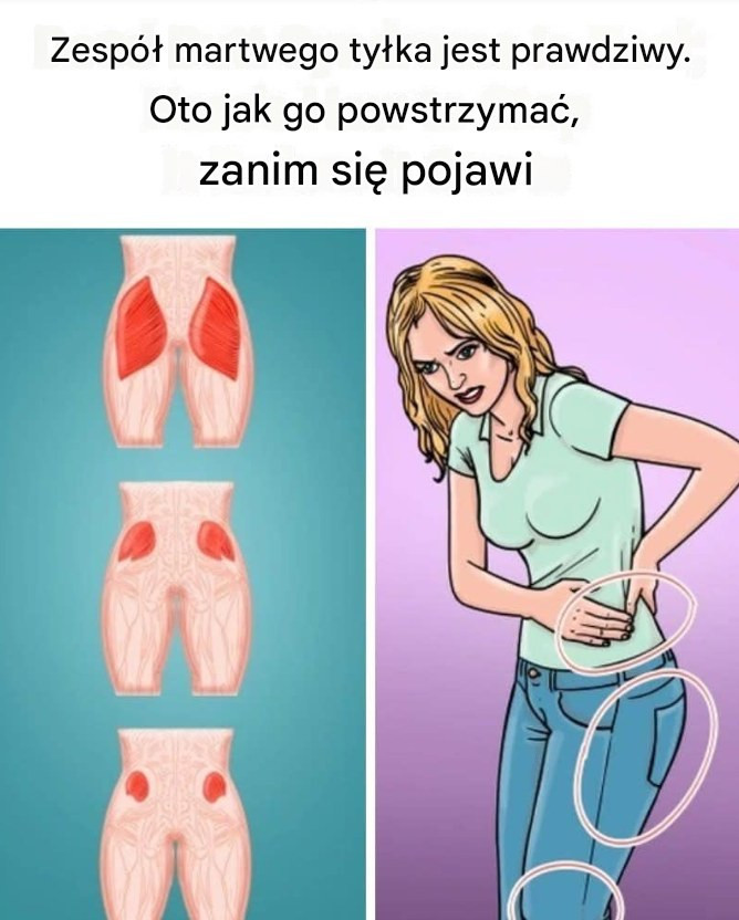 Syndrom_martwego_ty_ka__zwany_tak_e_amnezj__po_ladkow___to_coraz_cz__ciej_rozpoznawana_dolegliwo___zwi_zana_z_d_ugotrwa_ym_siedz_cym_trybem__ycia_ Syndrom_martwego_ty_ka__zwany_tak_e_amnezj__po_ladkow___to_coraz_cz__ciej_rozpoznawana_dolegliwo___zwi_zana_z_d_ugotrwa_ym_siedz_cym_trybem__ycia_