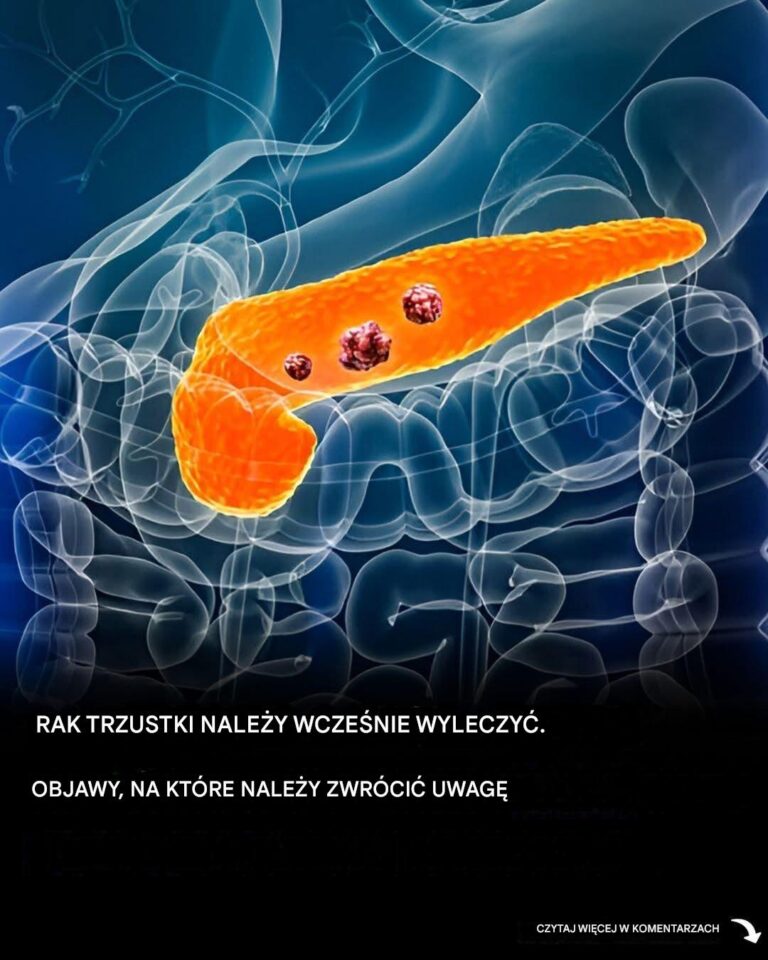 10_objaw_w_raka_trzustki__kt_rych_nigdy_nie_nale_y_ignorowa_