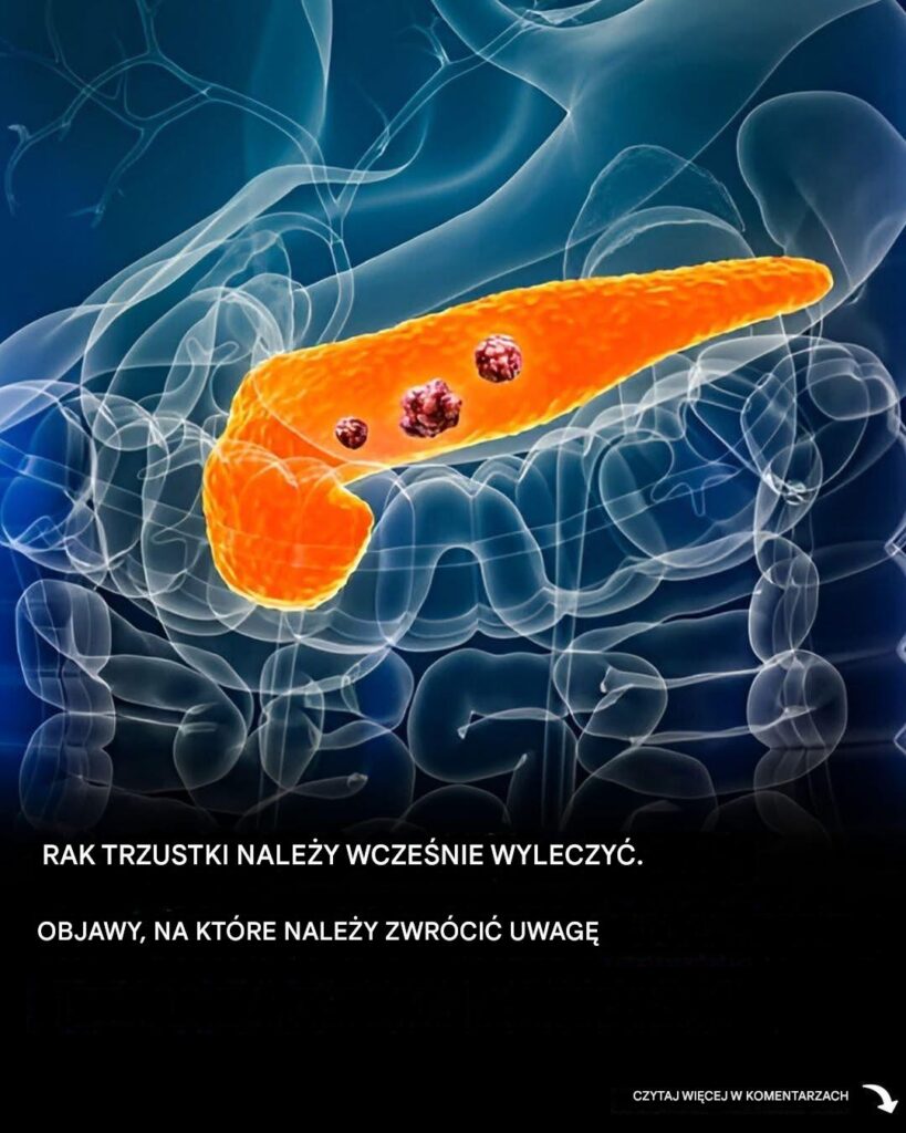 10_objaw_w_raka_trzustki__kt_rych_nigdy_nie_nale_y_ignorowa_ 10_objaw_w_raka_trzustki__kt_rych_nigdy_nie_nale_y_ignorowa_