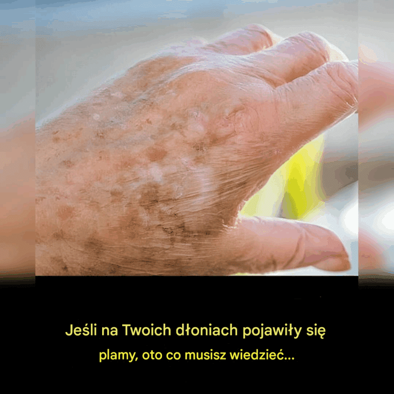 Czy_wiesz___e_je_li_plamy_pojawi__si__na_twoich_r_kach__to_wyra_ny_znak___e__8230_