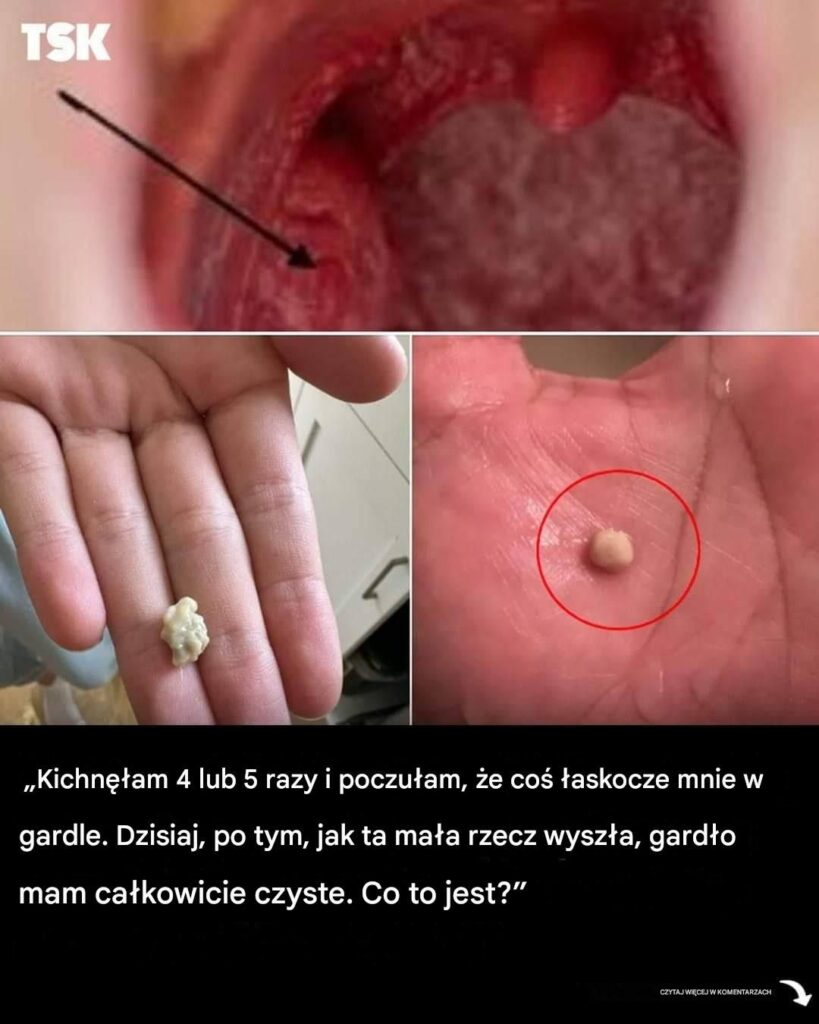 Dowiedz_si___jakie_s__przyczyny__objawy_i_mo_liwo_ci_leczenia_kamieni_migda_kowych_-1 Dowiedz_si___jakie_s__przyczyny__objawy_i_mo_liwo_ci_leczenia_kamieni_migda_kowych_-1