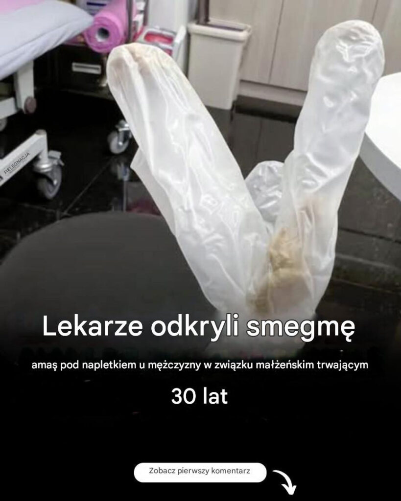 Lekarze_odkryli_nagromadzenie_smegmy_pod_napletkiem_30_letniego_m__czyzny__kt_ry_cierpia__z_powodu_potwornego_b_lu Lekarze_odkryli_nagromadzenie_smegmy_pod_napletkiem_30_letniego_m__czyzny__kt_ry_cierpia__z_powodu_potwornego_b_lu