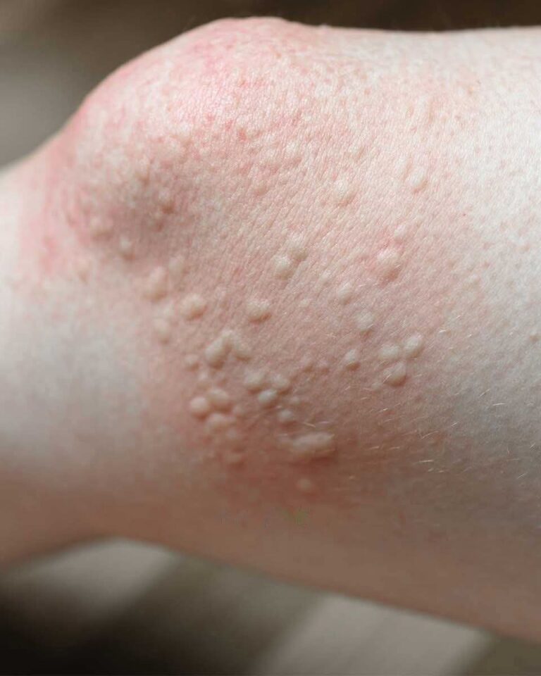 Ostrze_enie_dermatologiczne__Te_guzki_wok___kolan_mog__wskazywa__na_ukryty_problem_zdrowotny___dowiedz_si___co_zrobi___zanim_b_dzie_za_p__no