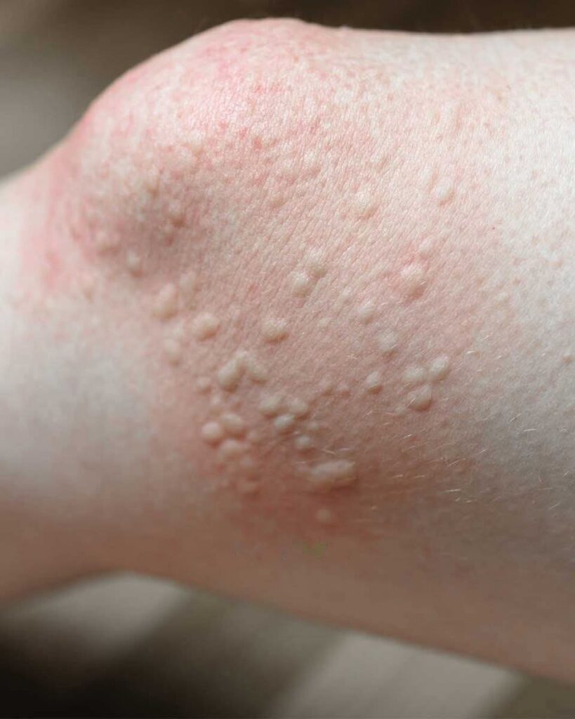 Ostrze_enie_dermatologiczne__Te_guzki_wok___kolan_mog__wskazywa__na_ukryty_problem_zdrowotny___dowiedz_si___co_zrobi___zanim_b_dzie_za_p__no Ostrze_enie_dermatologiczne__Te_guzki_wok___kolan_mog__wskazywa__na_ukryty_problem_zdrowotny___dowiedz_si___co_zrobi___zanim_b_dzie_za_p__no