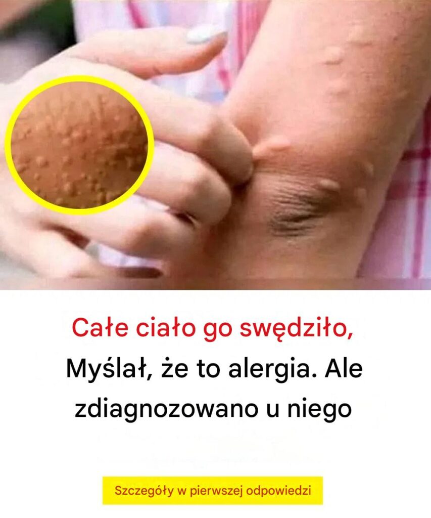 Zijn_hele_lichaam_jeukte__hij_dacht_dat_het_een_allergie_was_en_kreeg_de_diagnose Zijn_hele_lichaam_jeukte__hij_dacht_dat_het_een_allergie_was_en_kreeg_de_diagnose