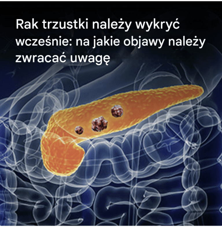 10_objaw_w_raka_trzustki__kt_rych_nie_nale_y_ignorowa_