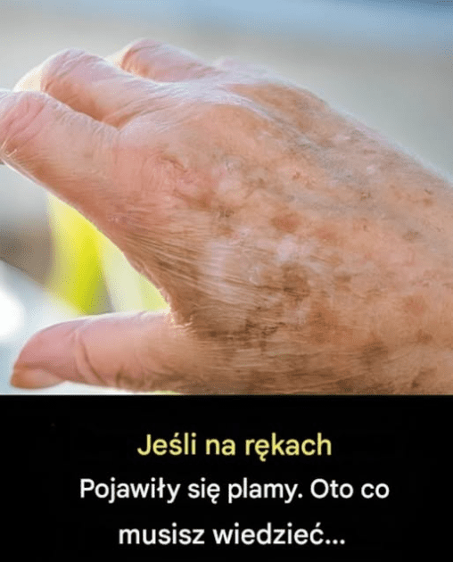 Dlaczego_na_d_oniach_pojawiaj__si__plamy_i_jak_si__ich_pozby__-1 Dlaczego_na_d_oniach_pojawiaj__si__plamy_i_jak_si__ich_pozby__-1