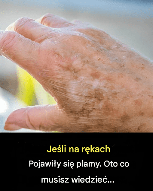 Dlaczego_na_d_oniach_pojawiaj__si__plamy_i_jak_si__ich_pozby__ Dlaczego_na_d_oniach_pojawiaj__si__plamy_i_jak_si__ich_pozby__