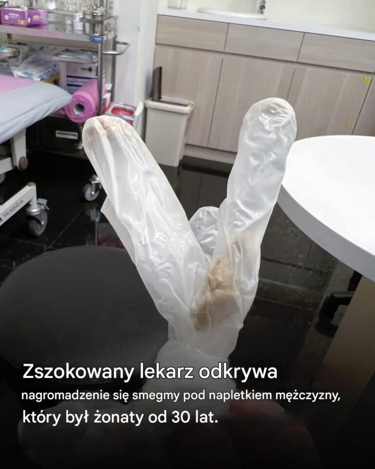 Lekarz_odkry__30_letni_nagromadzenie_smegmy_pod_napletkiem__onatego_m__czyzny__kt_ry_cierpia__na_potworny_b_l_