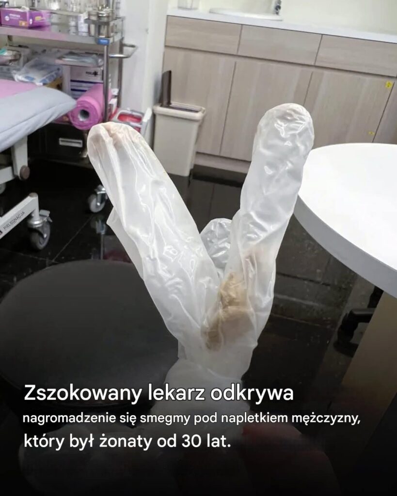 Lekarz_odkry__30_letni_nagromadzenie_smegmy_pod_napletkiem__onatego_m__czyzny__kt_ry_cierpia__na_potworny_b_l_