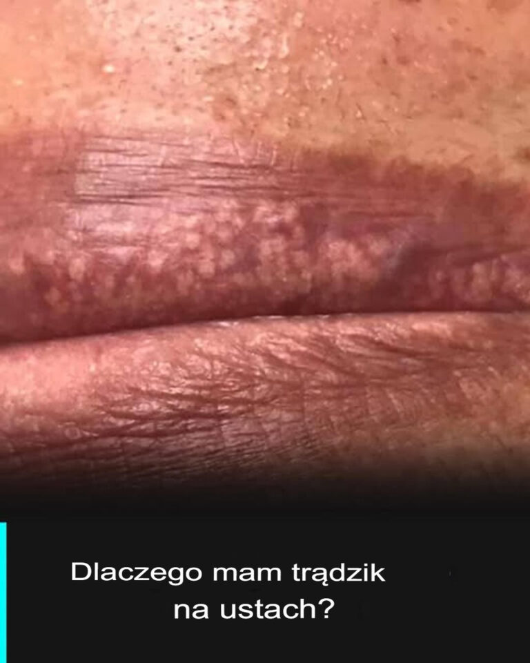 Miejsca_Fordyce__wszystko__co_musisz_wiedzie_