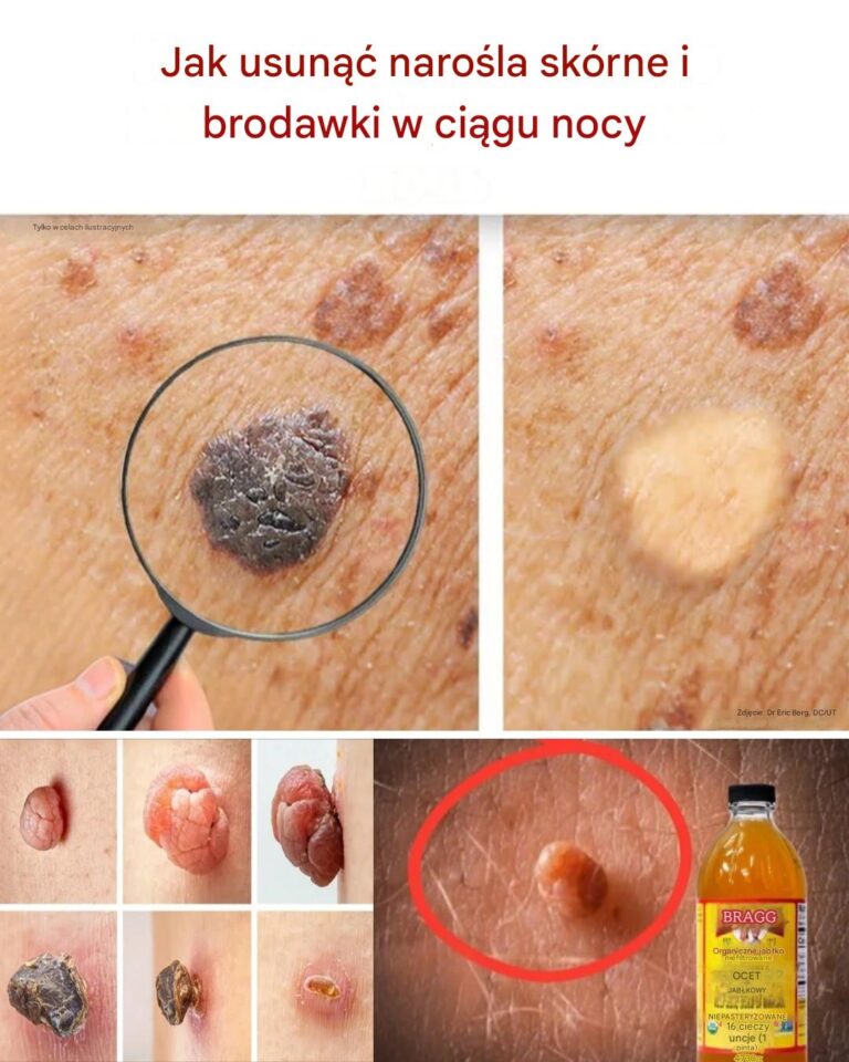 Pozb_d__si__brodawek_i_brodawczak_w_w_domu_przez_noc_