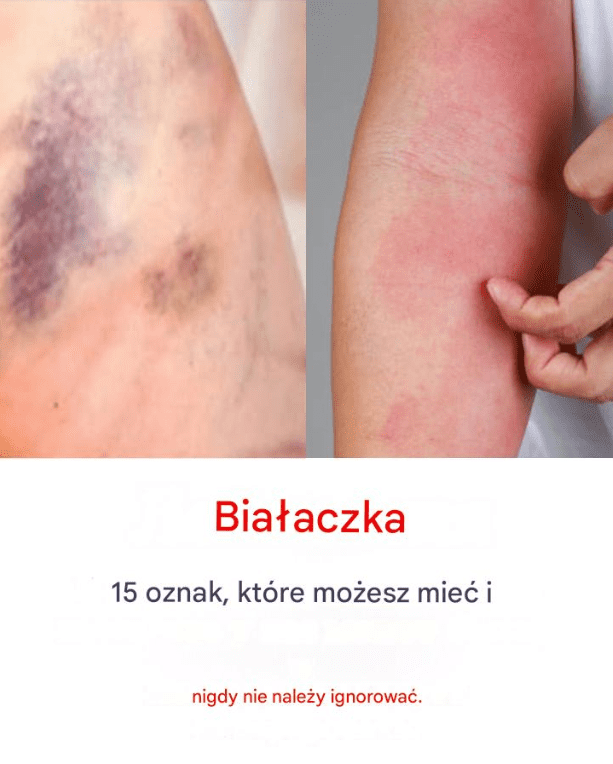 Rozpoznaj_objawy_bia_aczki__wczesne_wykrycie_ Rozpoznaj_objawy_bia_aczki__wczesne_wykrycie_