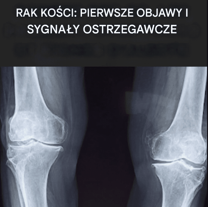 Wszystko__co_musisz_wiedzie__o_raku_ko_ci__objawy__kt_rych_nikt_nie_kojarzy_z_t__chorob_ Wszystko__co_musisz_wiedzie__o_raku_ko_ci__objawy__kt_rych_nikt_nie_kojarzy_z_t__chorob_