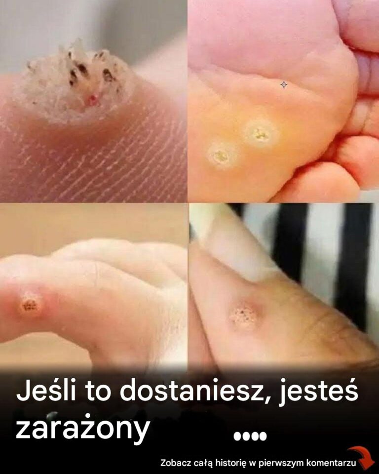 6_rodzaj_w_brodawek__objawy__symptomy__domowe_sposoby_leczenia_i_leczenie_