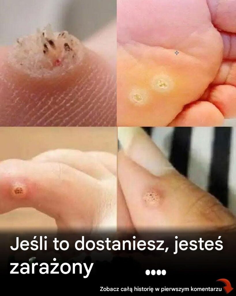 6_rodzaj_w_brodawek__objawy__symptomy__domowe_sposoby_leczenia_i_leczenie_ 6_rodzaj_w_brodawek__objawy__symptomy__domowe_sposoby_leczenia_i_leczenie_