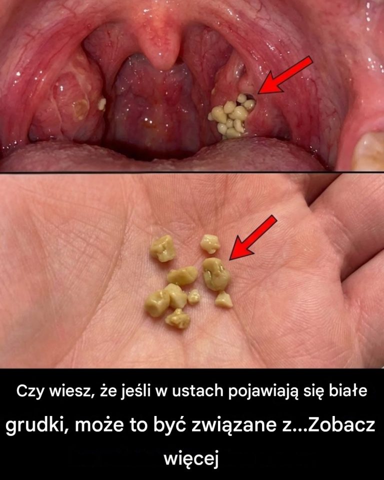 Kamienie_migda_kowe__Dowiedz_si___czym_s___jak_powstaj__i_jak_wyp_ywaj__ich_na_zawsze_-1