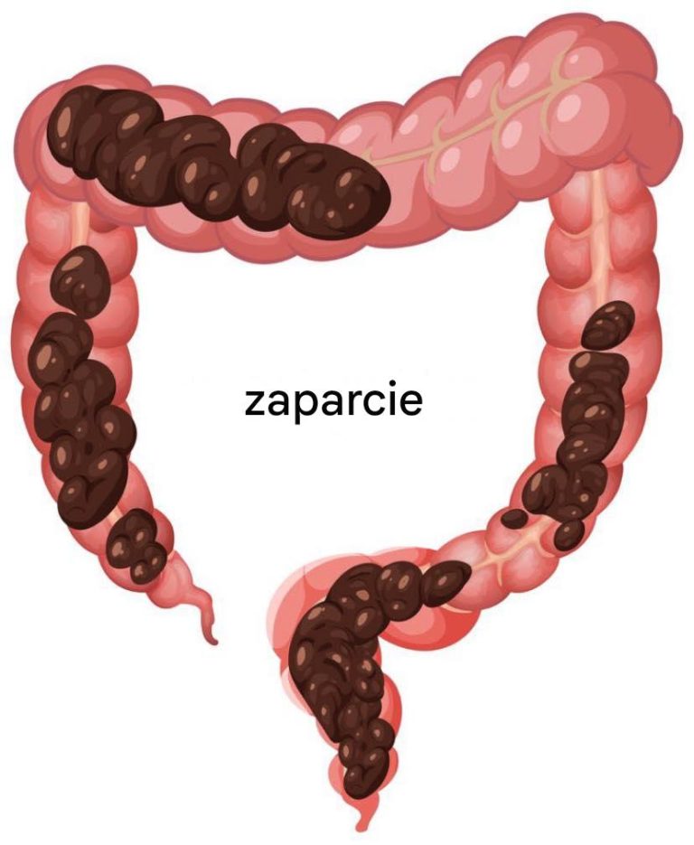 Naturalne_sposoby_radzenia_sobie_z_zaparciami