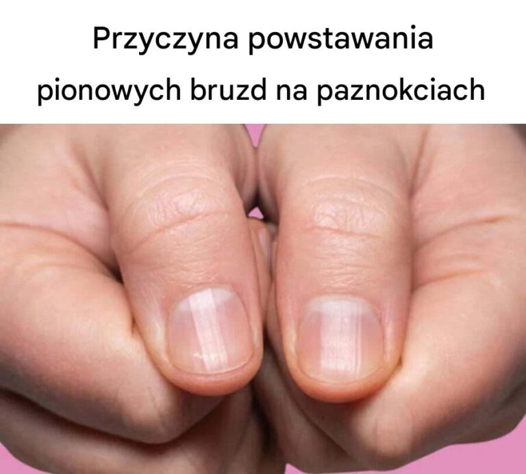 Przyczyna_powstawania_pionowych_bruzd_na_paznokciach