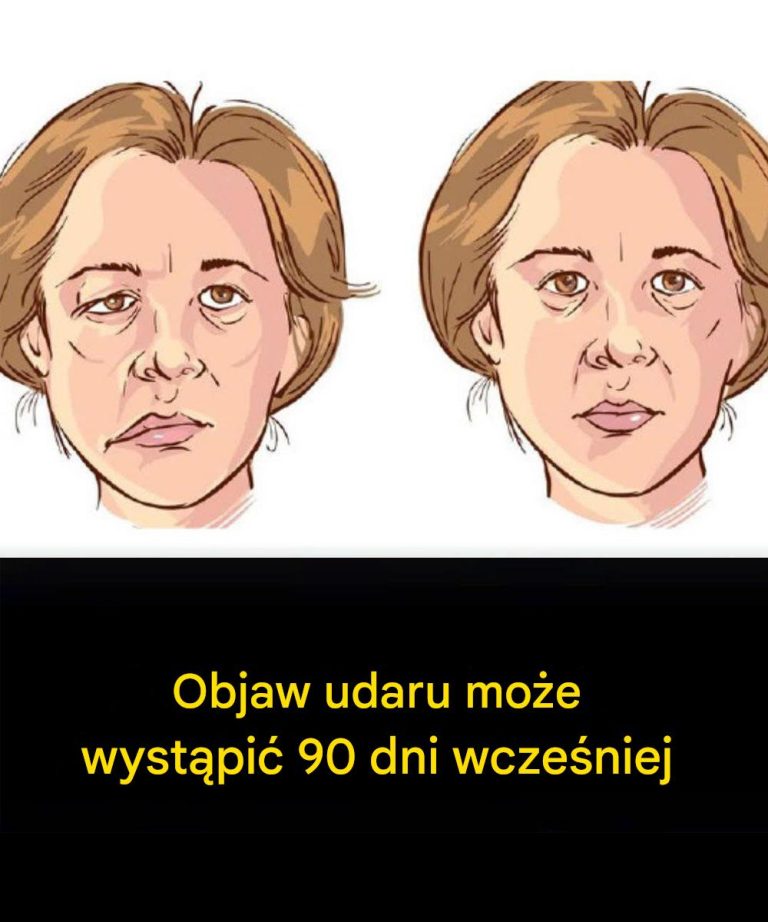 Objaw_udaru_mo_e_wyst_pi__90_dni_wcze_niej