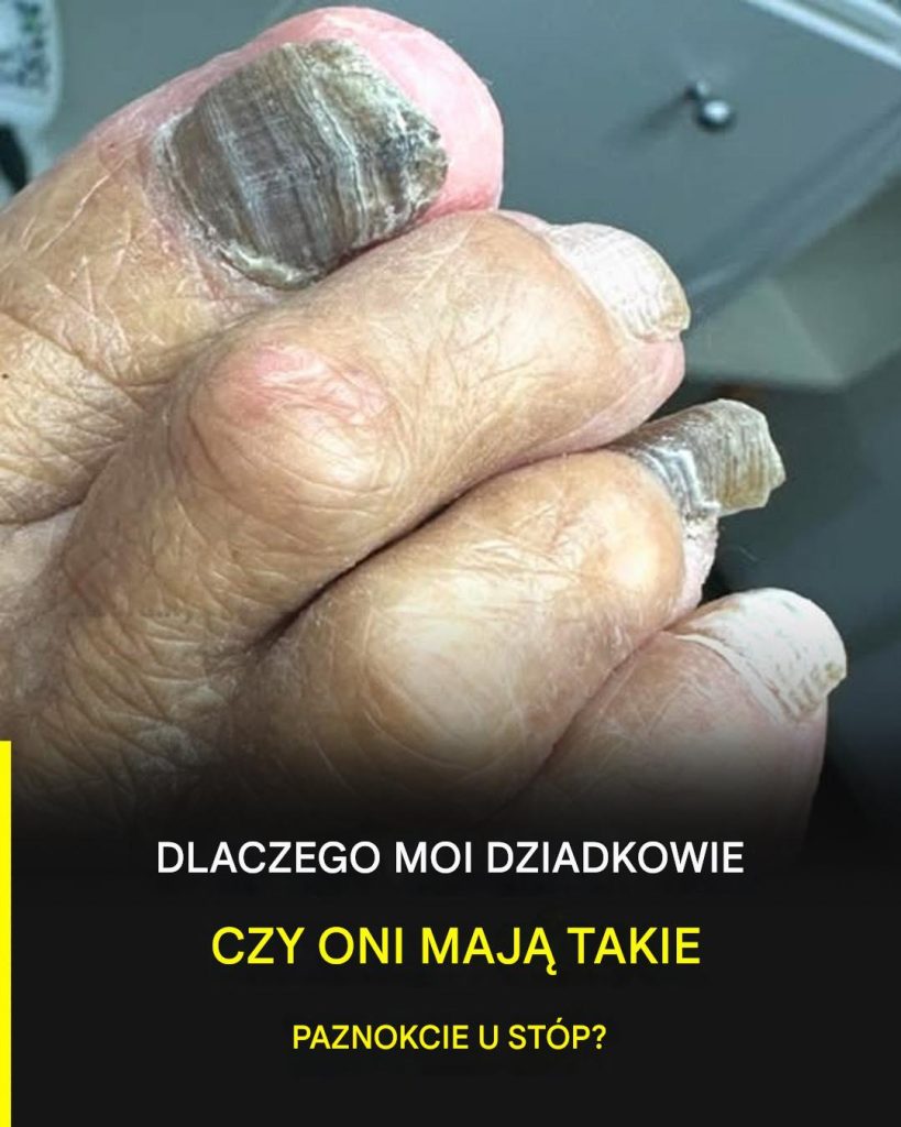 Paznokcie_starca___dlaczego_zmieniaj__si__z_wiekiem_i_co_m_wi__o_Twoim_zdrowiu Paznokcie_starca___dlaczego_zmieniaj__si__z_wiekiem_i_co_m_wi__o_Twoim_zdrowiu
