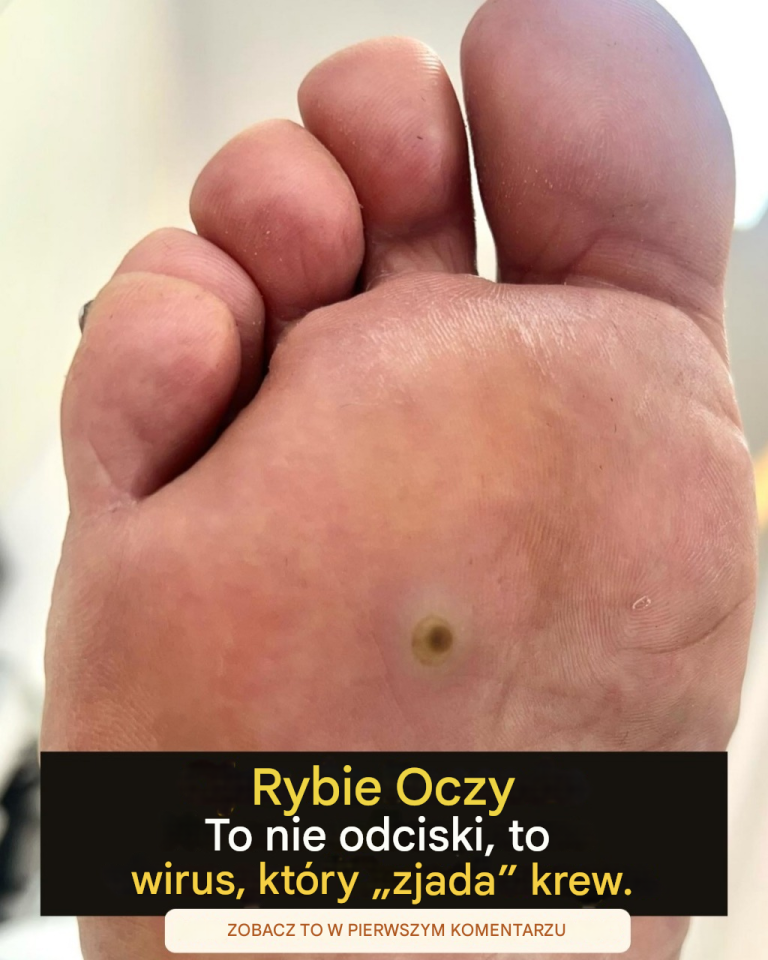 Rybie_oko__niewielka_rana_na_zewn_trz__ale_o_wiele_bardziej_z_o_ona_w__rodku_